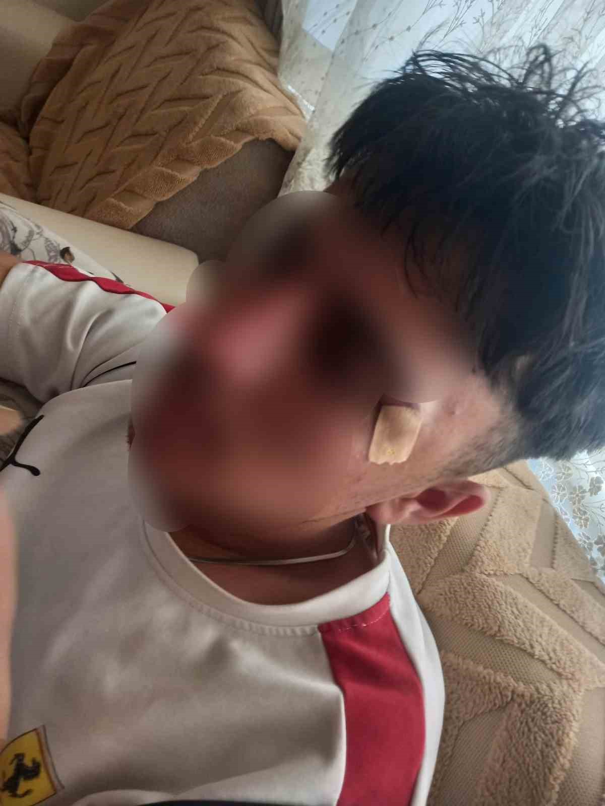 Öğretmenin kafa attığı çocuğun burnu kırıldı